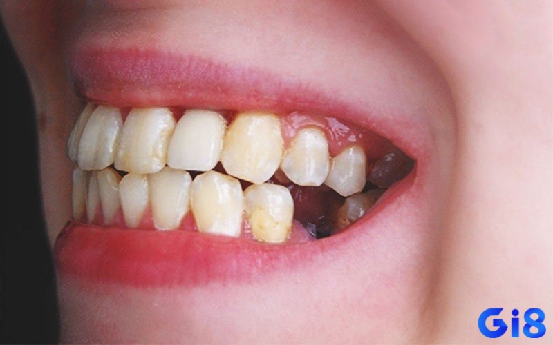 Các biến thể khác nhau khi giải mã giấc mơ bị rụng răng mang những ý nghĩa riêng biệt